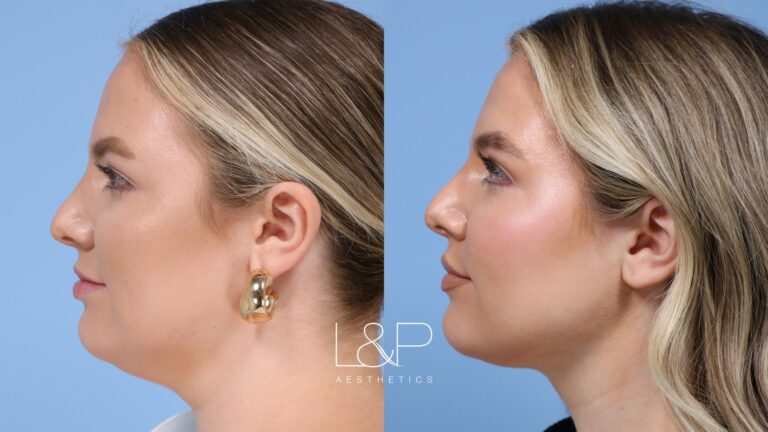 Facetite / Accutite Before and after treatment