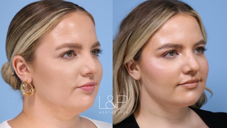 Facetite / Accutite Before and after treatment