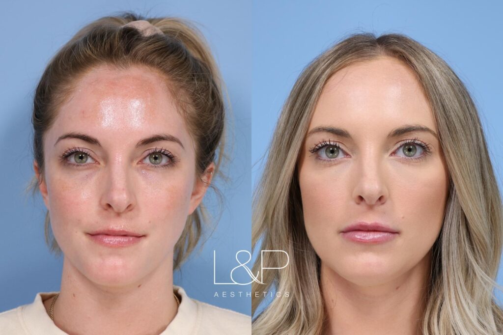 Facial Fillers before and after treatment