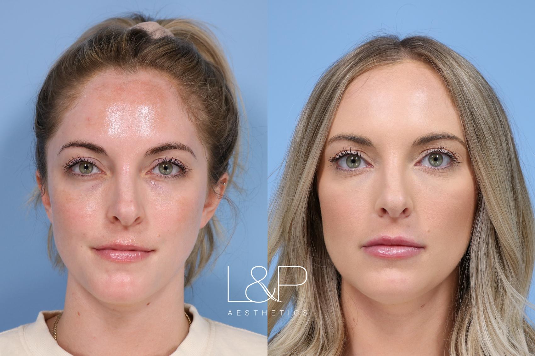 Facial Fillers before and after treatment