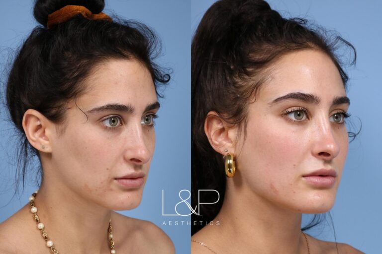 Facial Fillers before and after treatment