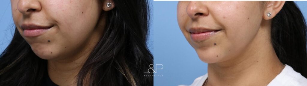 Facial Fillers before and after treatment