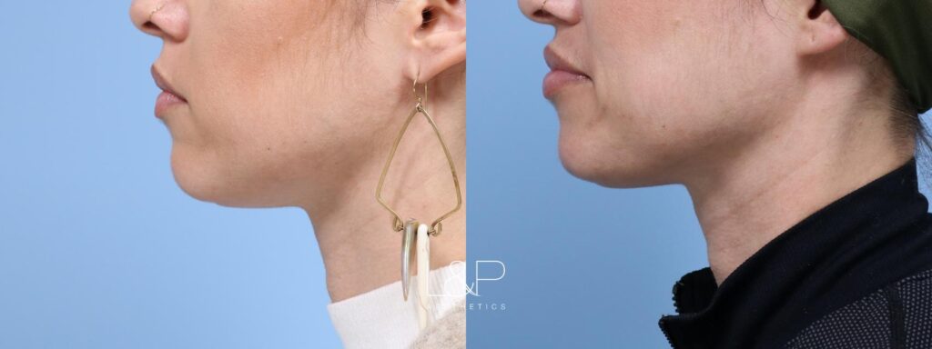 Facial Fillers before and after treatment