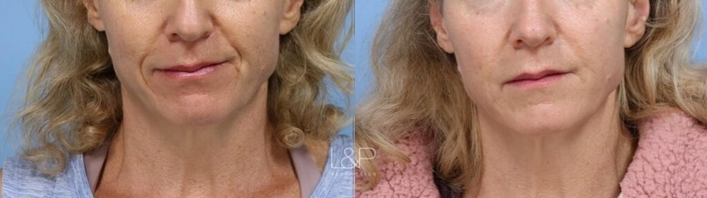 Facial Fillers before and after treatment