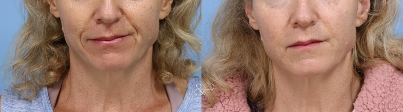 Facial Fillers before and after treatment