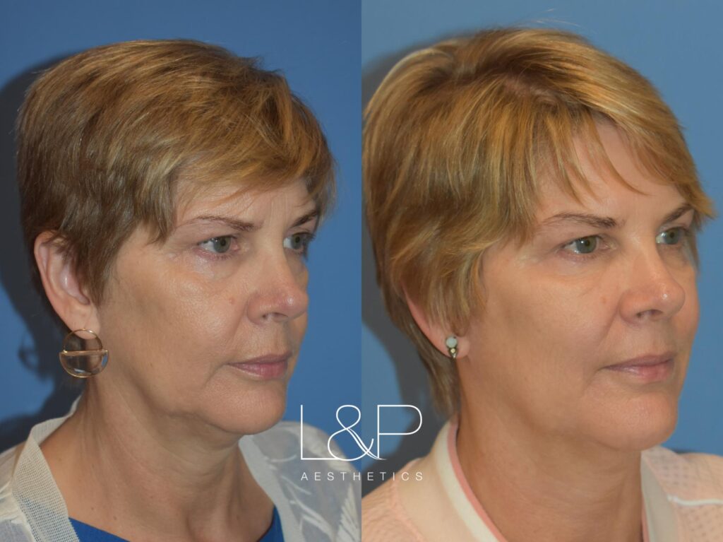 Facial Fillers before and after treatment
