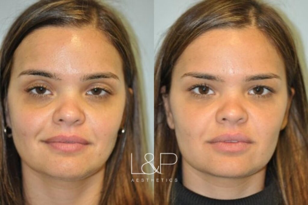 Facial Fillers before and after treatment