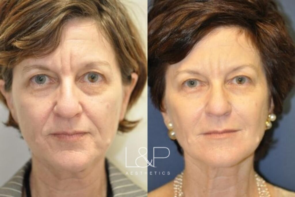 Facial Fillers before and after treatment