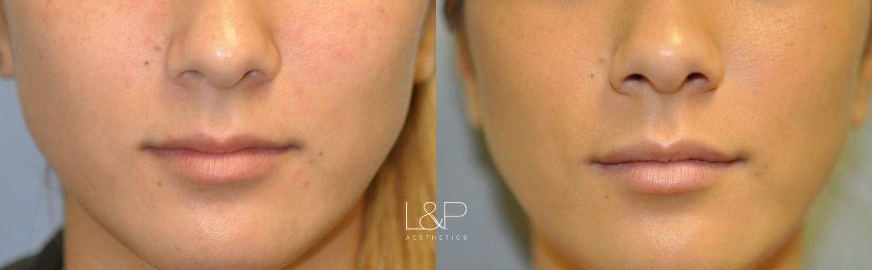 Facial Fillers before and after treatment