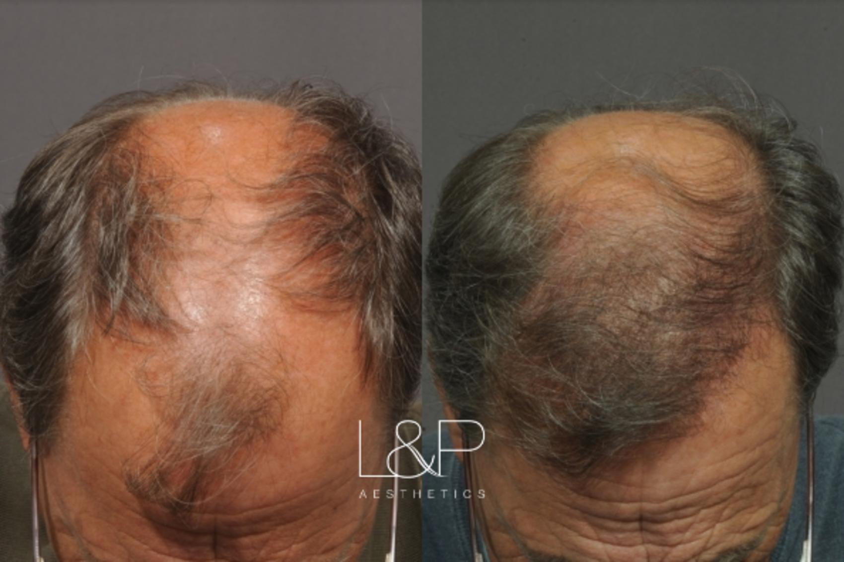 Hair Restoration before and after treatment
