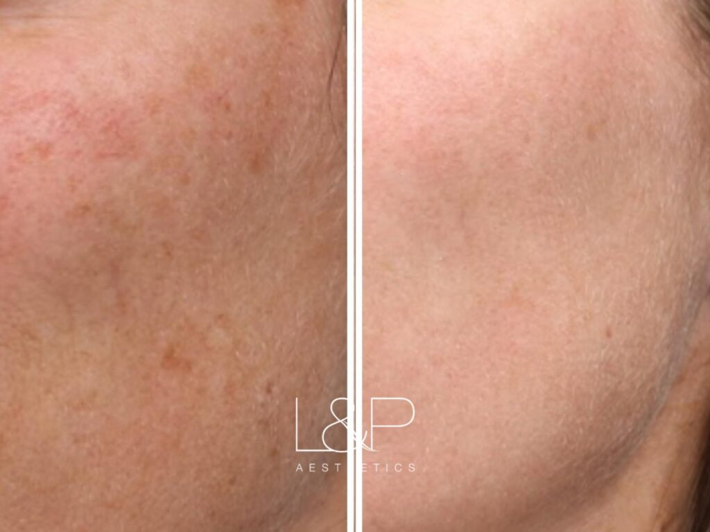 Young BBL before and after treatment