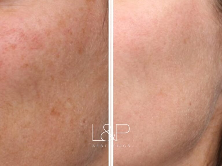 Young BBL before and after treatment
