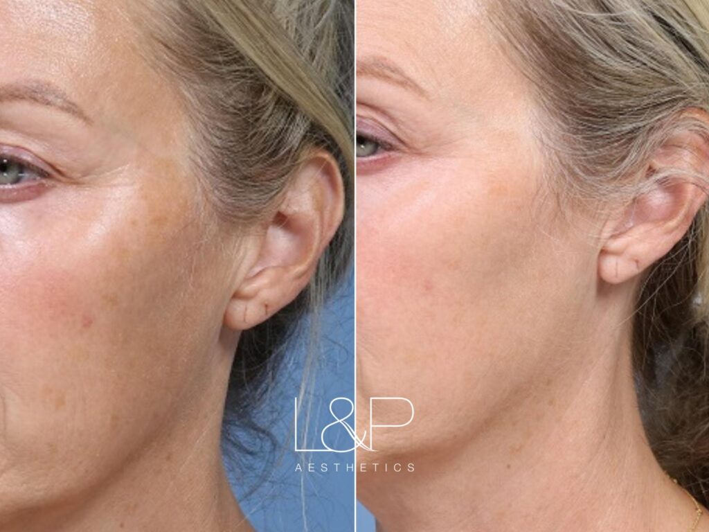 Young BBL before and after treatment