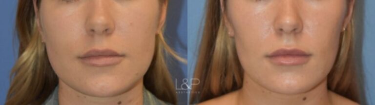 Jaw Slimming before and after treatment