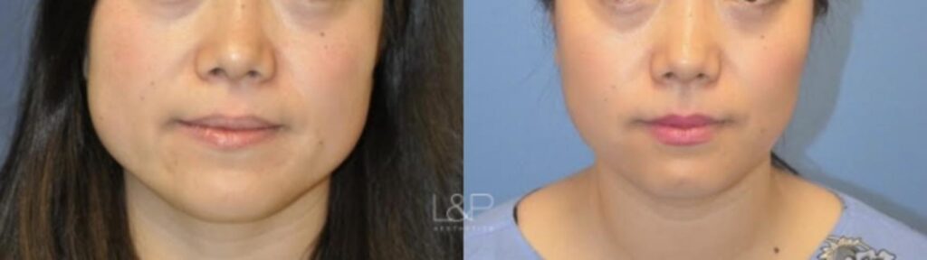Jaw Slimming before and after treatment