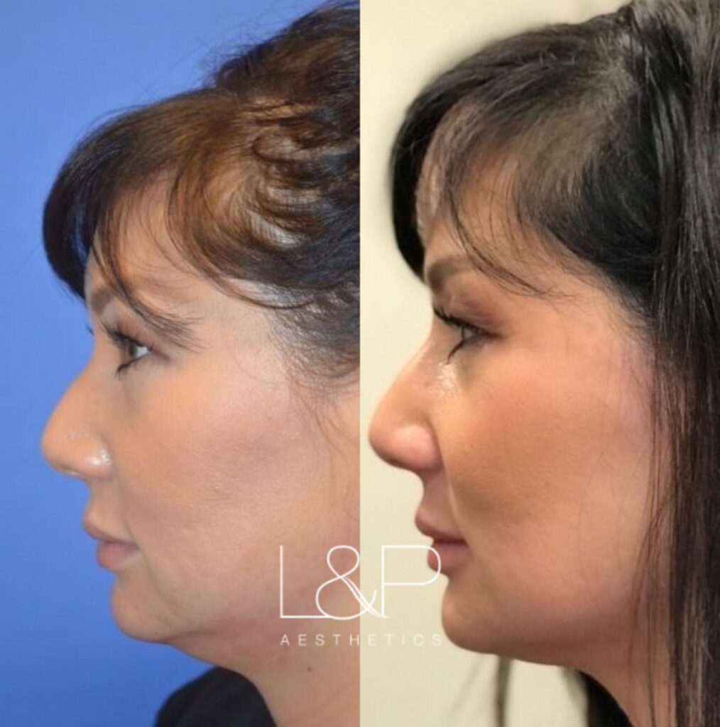 Kybella before and after treatment