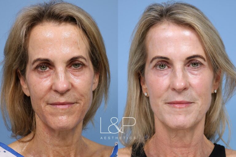 Laser Resurfacing before and after treatment in Los Gatos, California