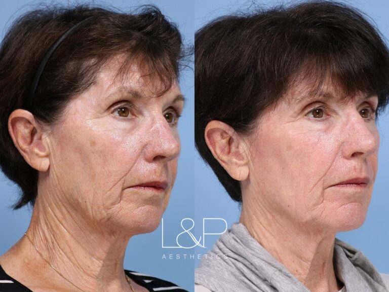Laser Resurfacing before and after treatment in the Bay Area