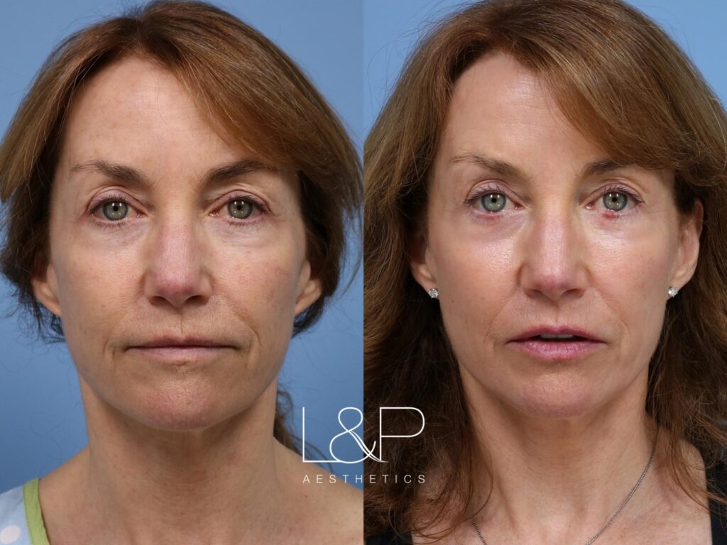 Laser Resurfacing before and after treatment in Los Gatos, CA