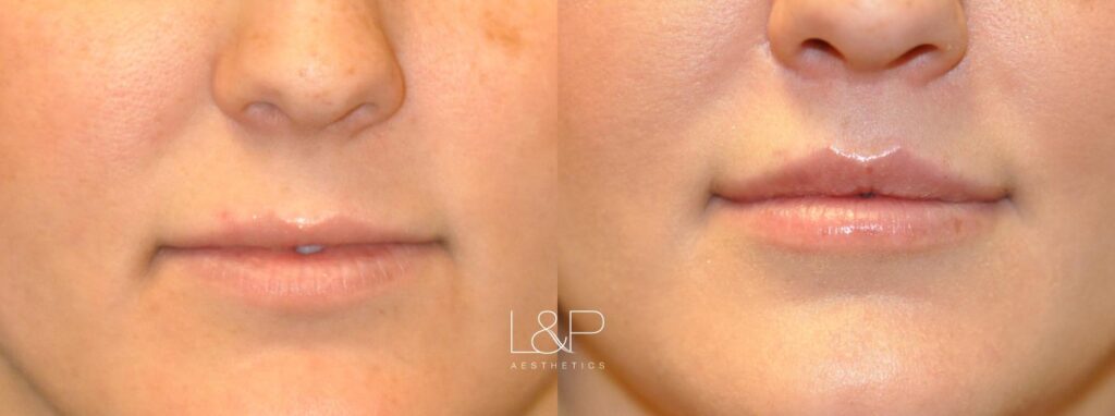 Lip Augmentation before and after treatment