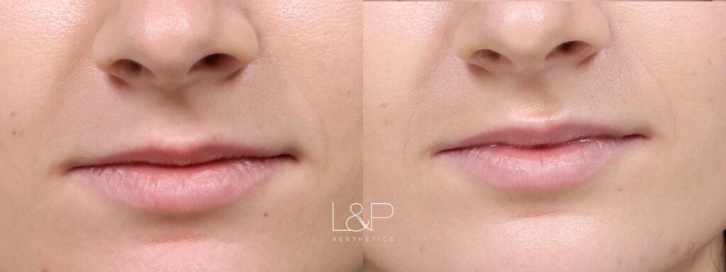 Lip Augmentation before and after treatment