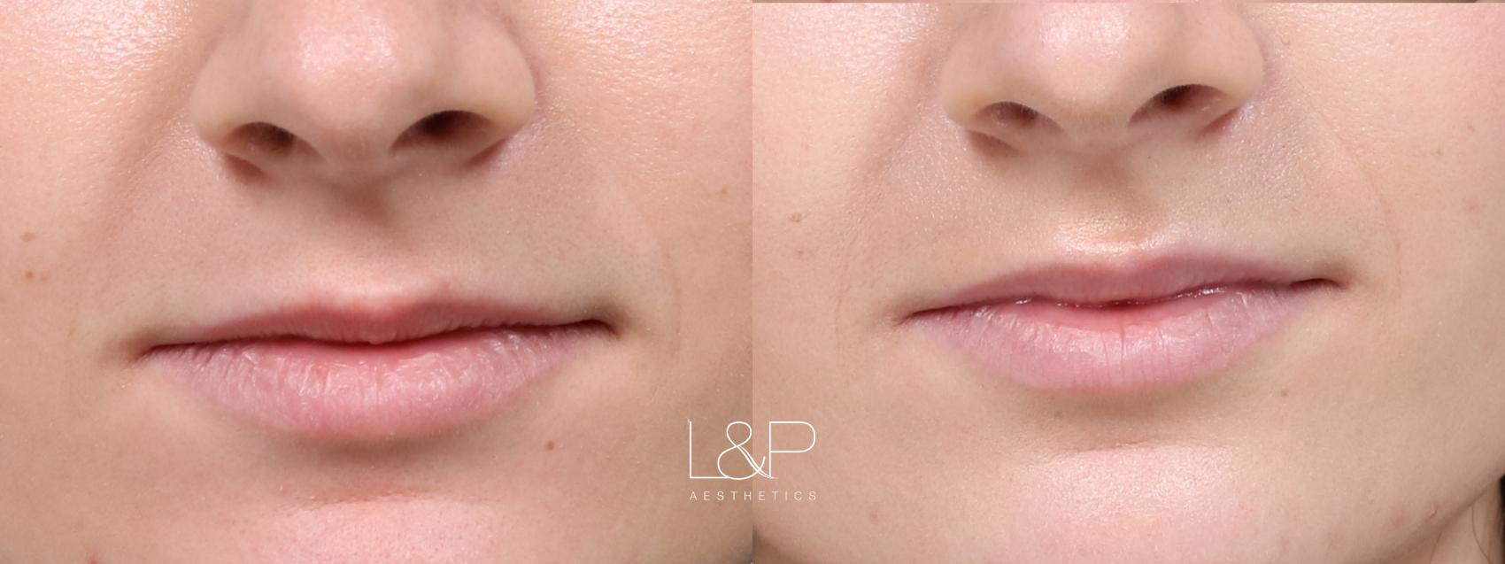 Lip Augmentation before and after treatment