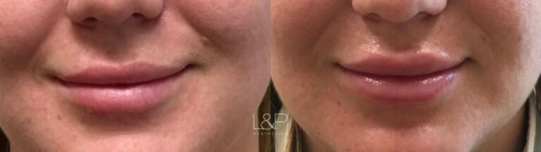 Lip Augmentation before and after treatment