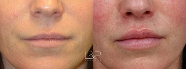 Lip Lift before and after treatment in Los Gatos, CA