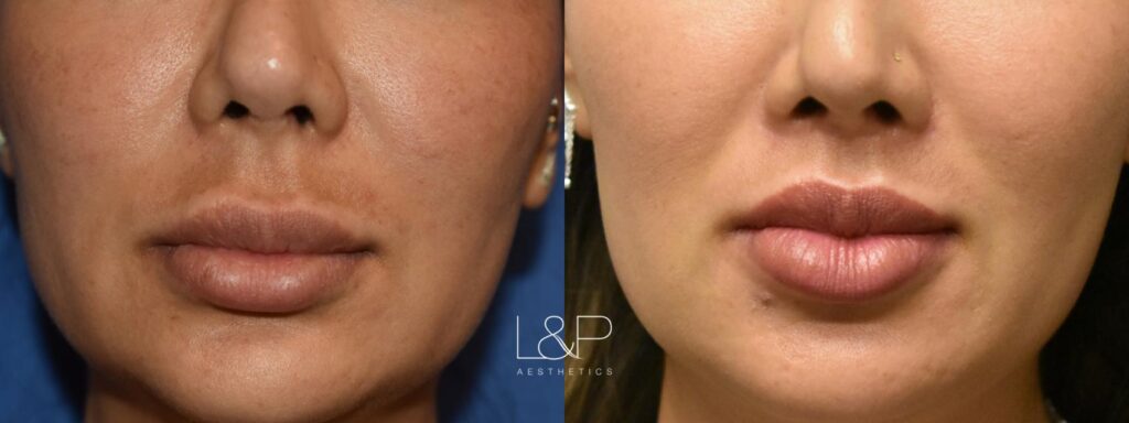 Lip Lift before and after treatment in Palo Alto, CA
