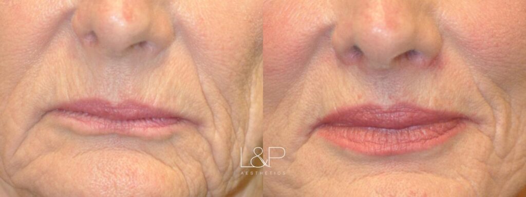 Lip Lift before and after treatment in California