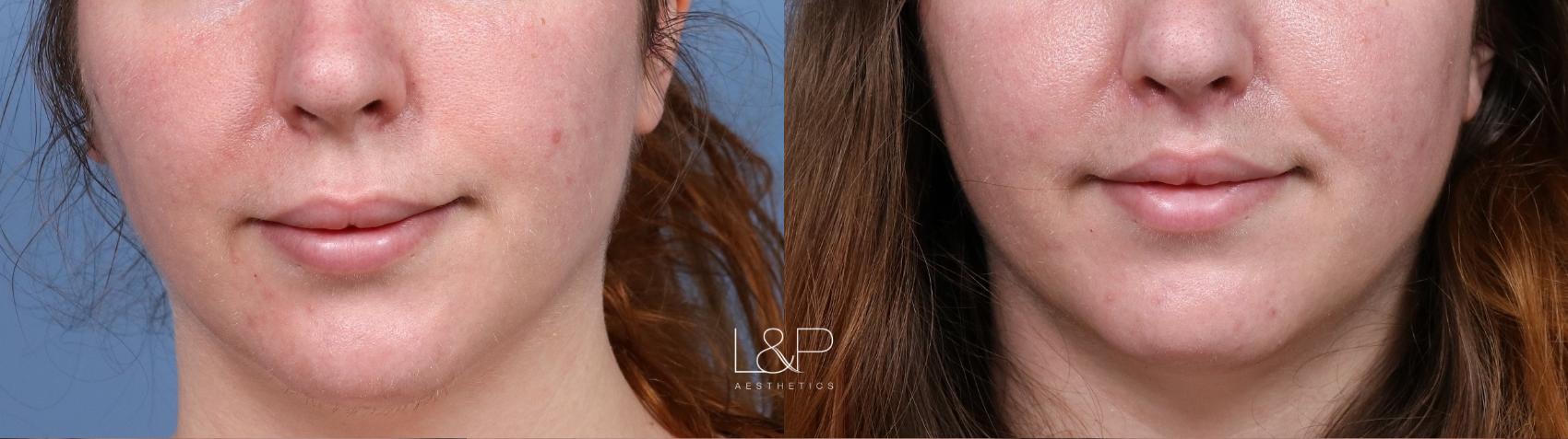 Lip Lift before and after treatment in Los Gatos, California