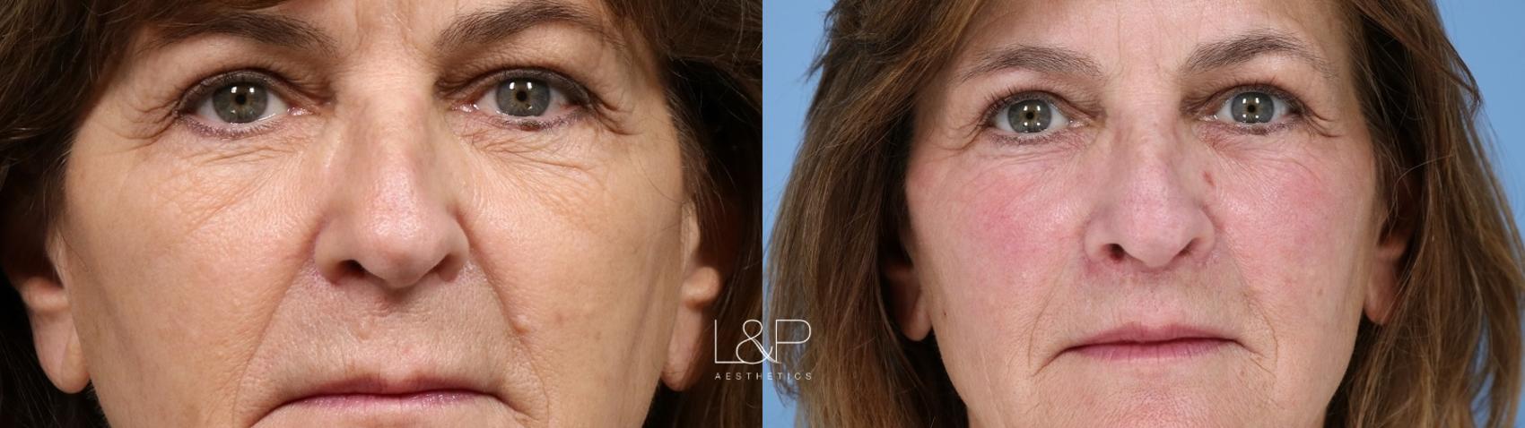 Lip Lift before and after treatment in California