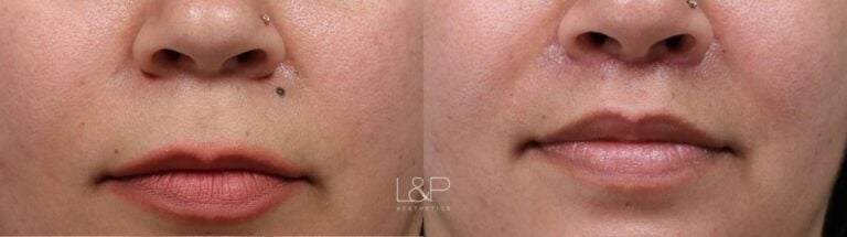 Lip Lift before and after treatment in Palo Alto, California