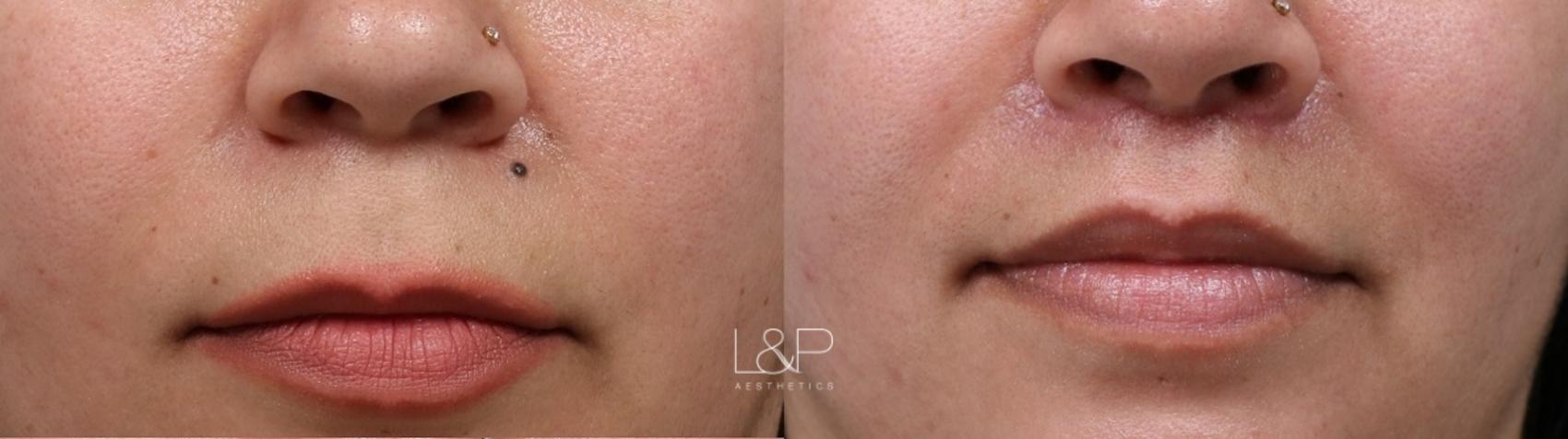 Lip Lift before and after treatment in Palo Alto, California