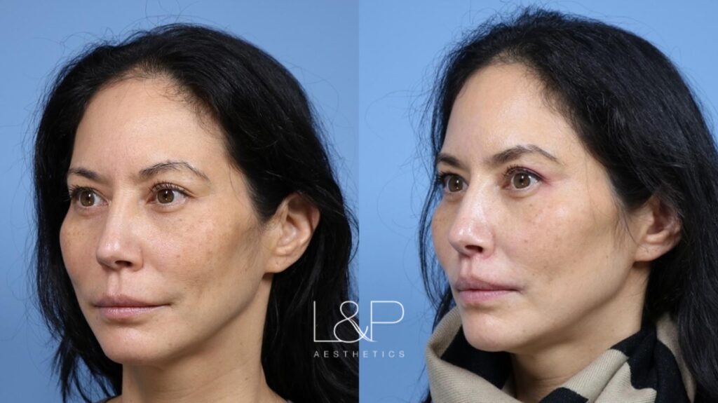 Lip Lift before and after treatment in the Bay Area