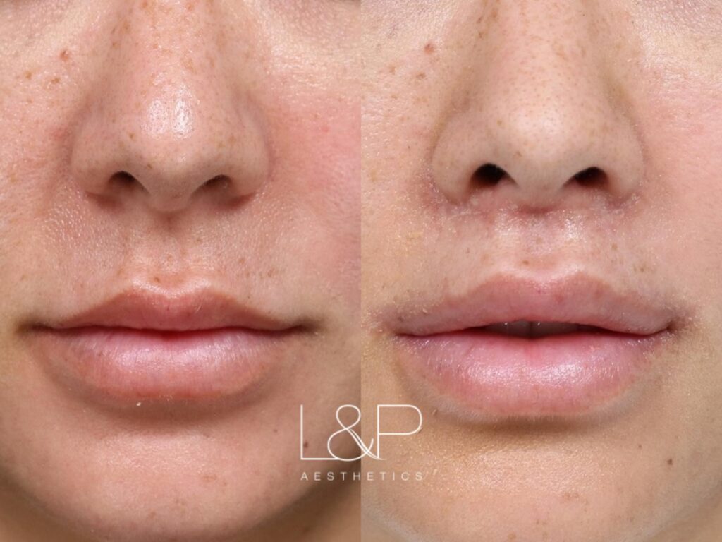 Lip Lift before and after treatment in Los Gatos, CA