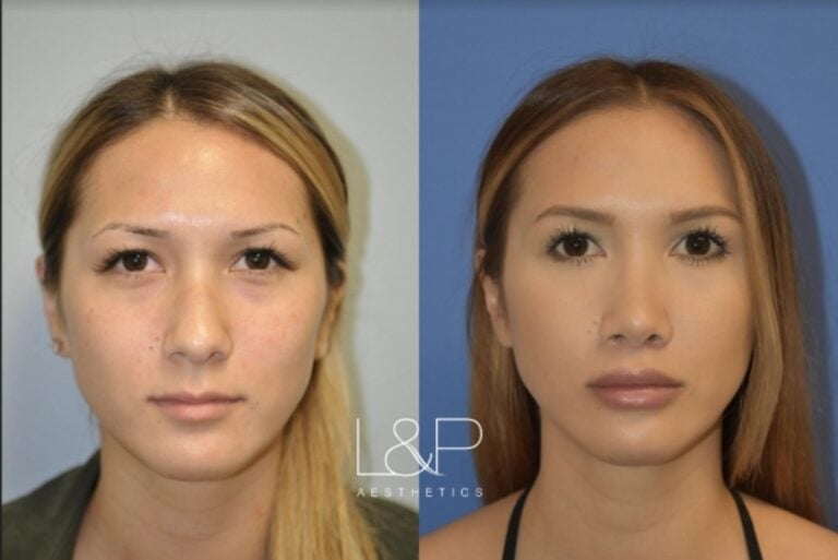 Lip Lift before and after treatment in California