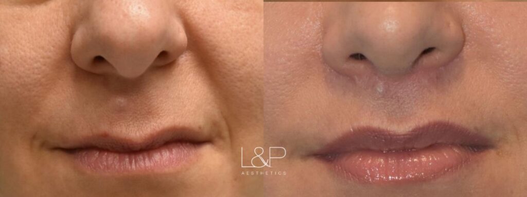 Lip Lift before and after treatment in CA