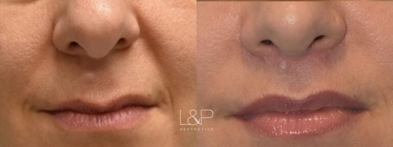 Lip Lift before and after treatment in CA