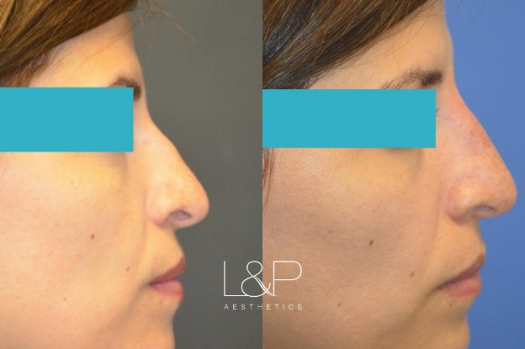 Liquid Rhinoplasty before and after treatment
