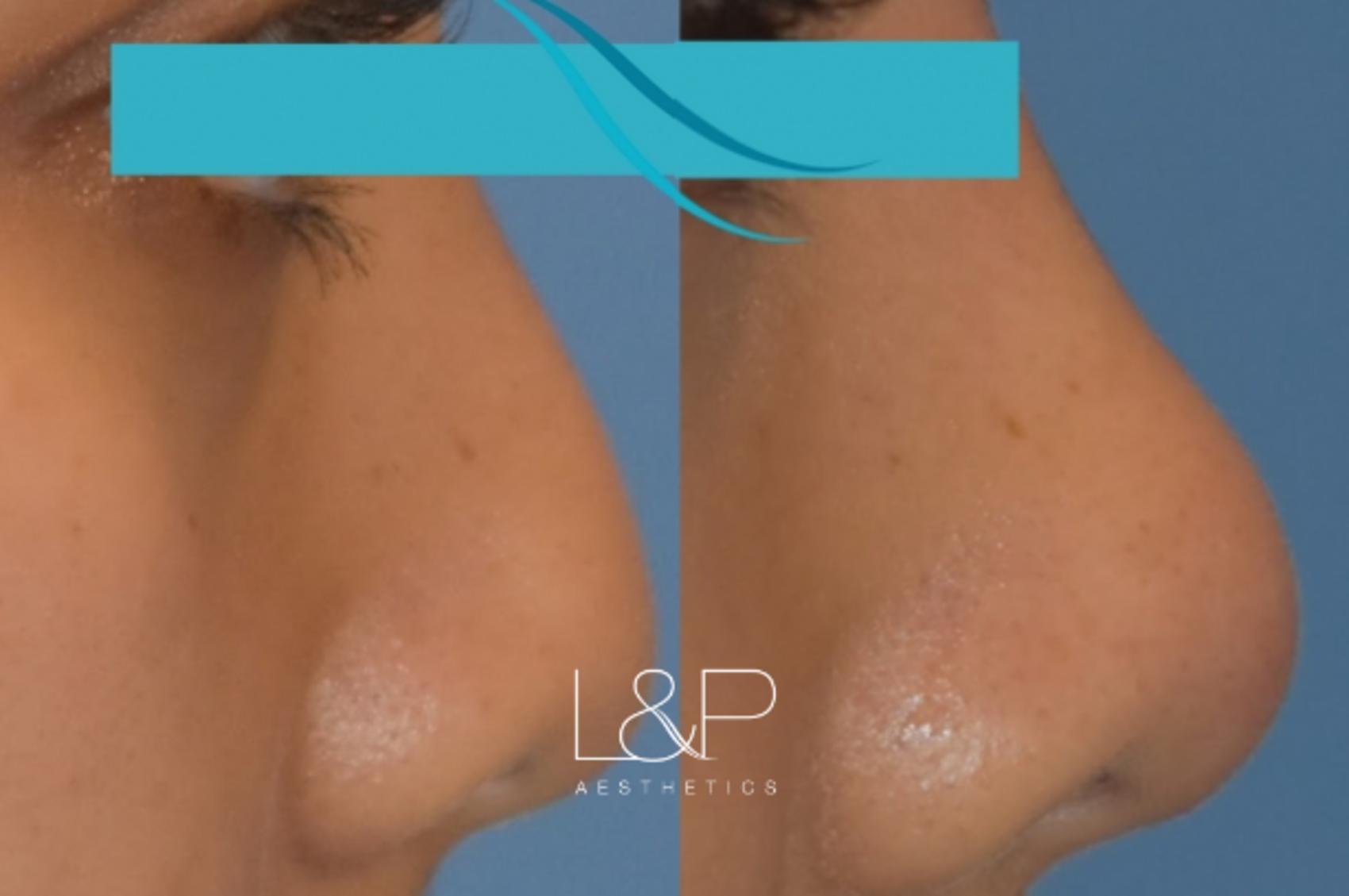 Liquid Rhinoplasty before and after treatment in Palo Alto, CA - Non Invasive Rhinoplasty