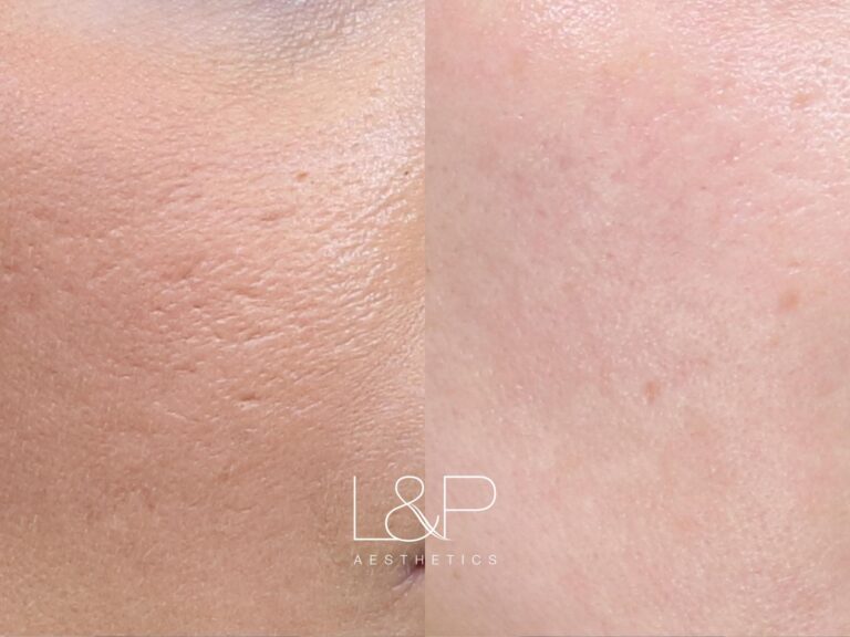 Microneedling Before and after treatment