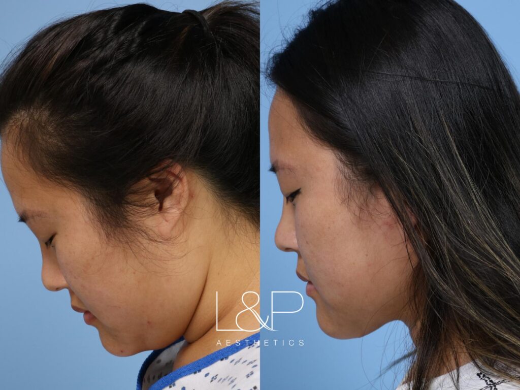 Midline Neck Lift before and after treatment in Los Gatos, CA