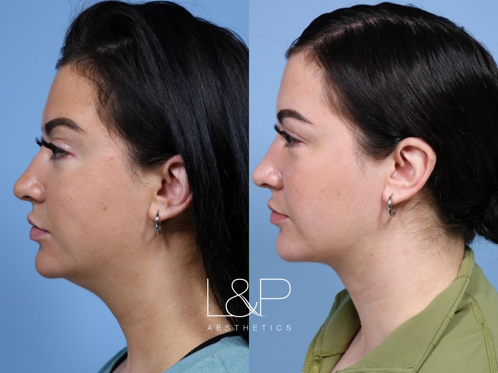 Midline Neck Lift before and after treatment in Palo Alto, CA - Midface Lift Palo Alto, CA