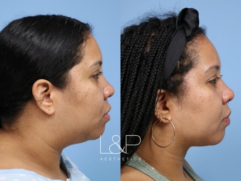 Midline Neck Lift before and after treatment - Midface Lift Palo Alto