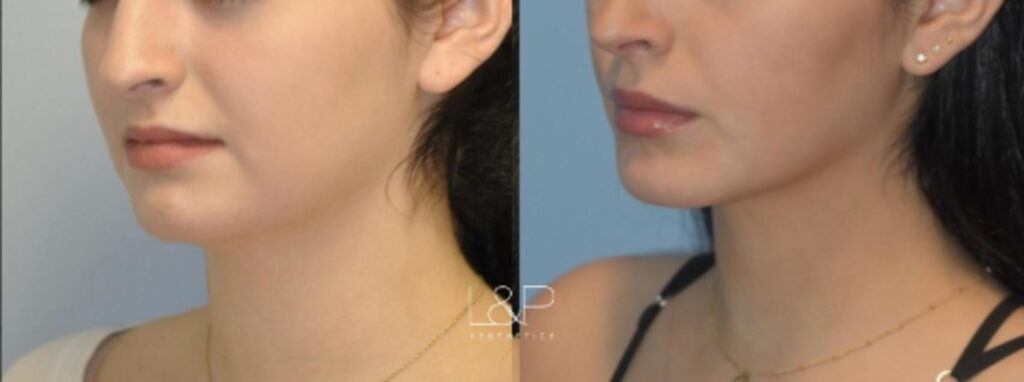 Midline Neck Lift before and after treatment - Midface Lift in Palo Alto