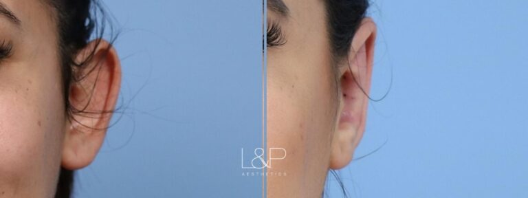Otoplasty before and after treatment