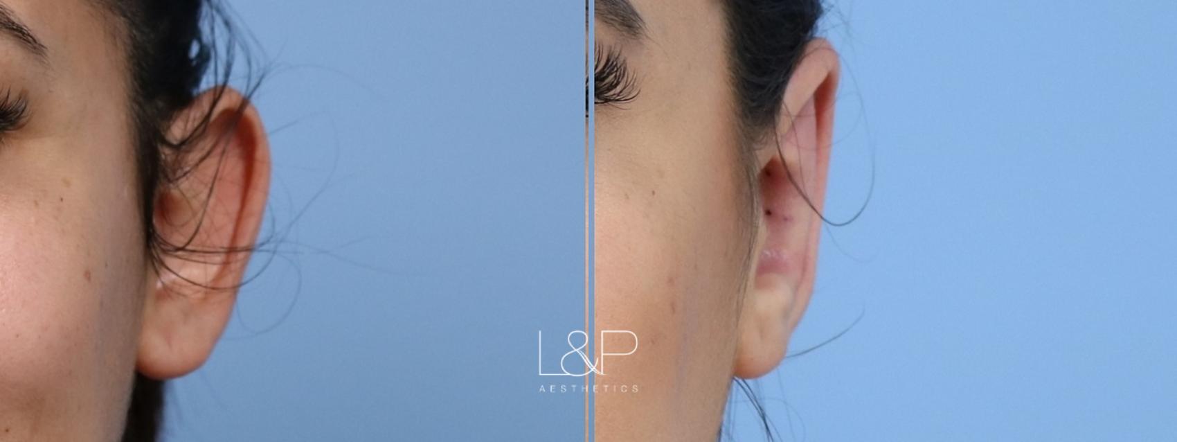 Otoplasty before and after treatment