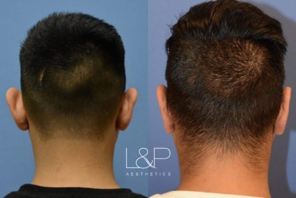 Otoplasty before and after treatment