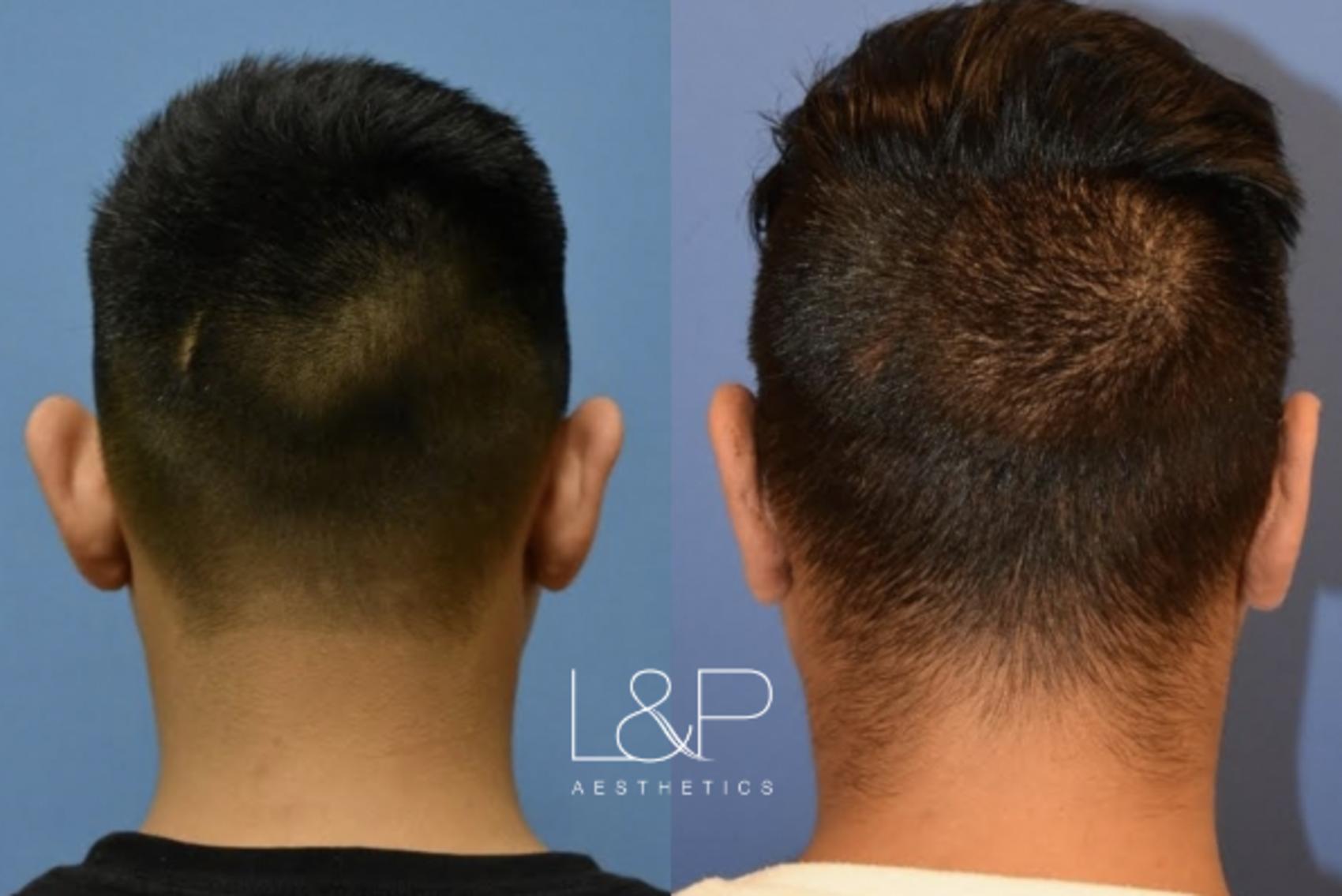 Otoplasty before and after treatment